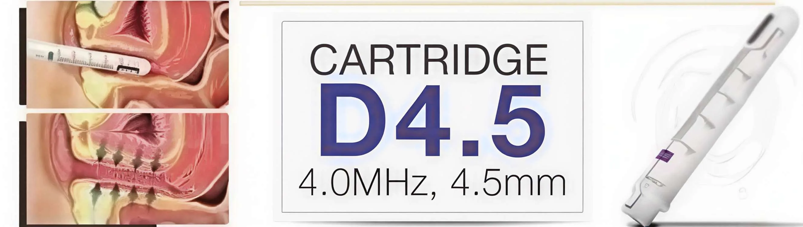 Cartouche Focus 4.5mm